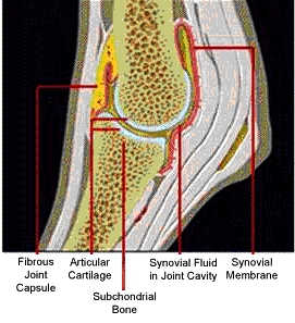 arthritis1